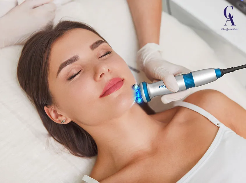 microneedling for sensitive skin