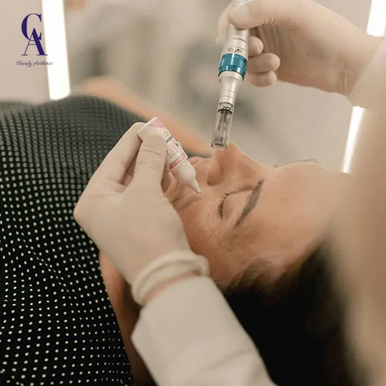 microneedling for sensitive skin
