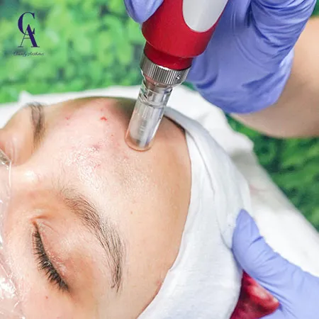 microneedling for sensitive skin