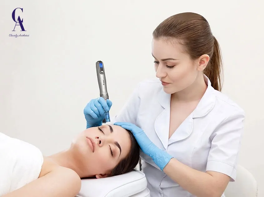 microneedling for sensitive skin